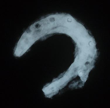 The x-ray clearly shows nail holes and other details