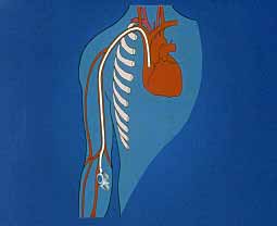 Fig.1. An access port for drug delivery