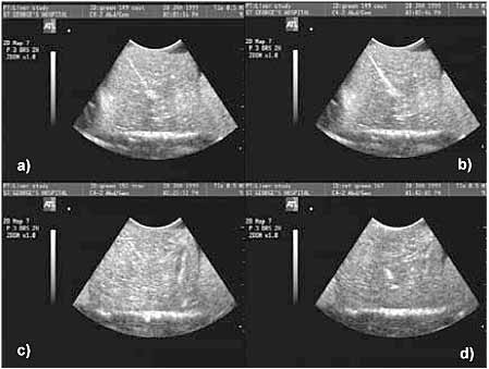Fig.6. Ultrasound images of sheep liver (green needles): a) Needle 149 at start of data collection; b) Needle 149 at end of data collection; c) Track left by needle 115 when removed; d) Uncoated reference needle (167) in liver 