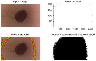 Figure 12 - Segmentation problems on skin pictures